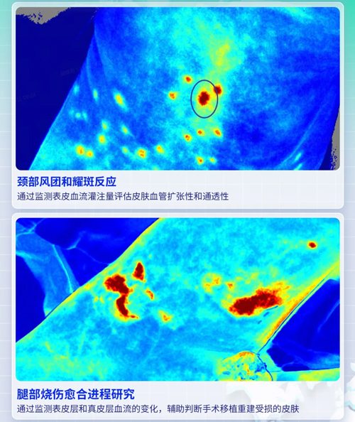 Z6·尊龙凯时激光散斑血流成像系统获批FDA认证