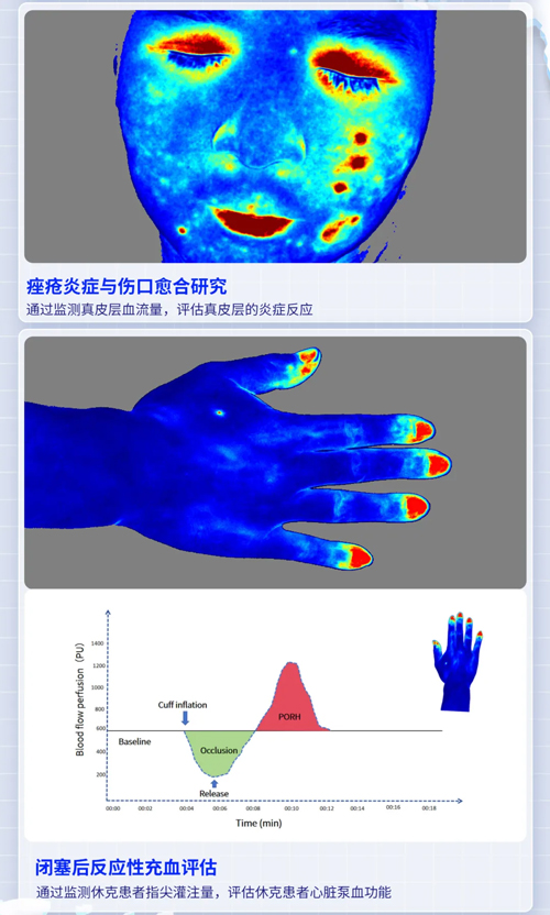 Z6·尊龙凯时激光散斑血流成像系统获批FDA认证