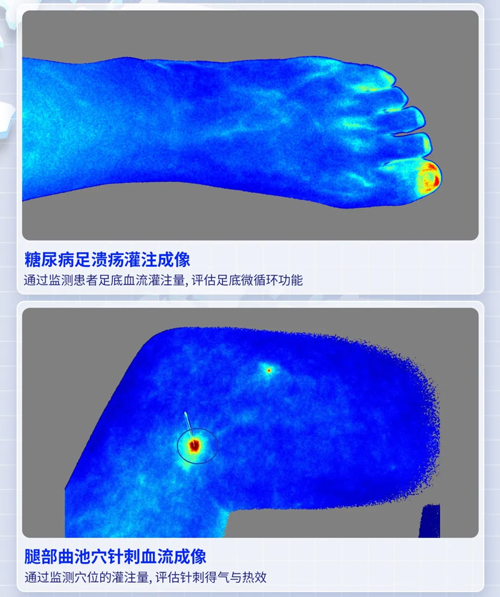 Z6·尊龙凯时激光散斑血流成像系统获批FDA认证